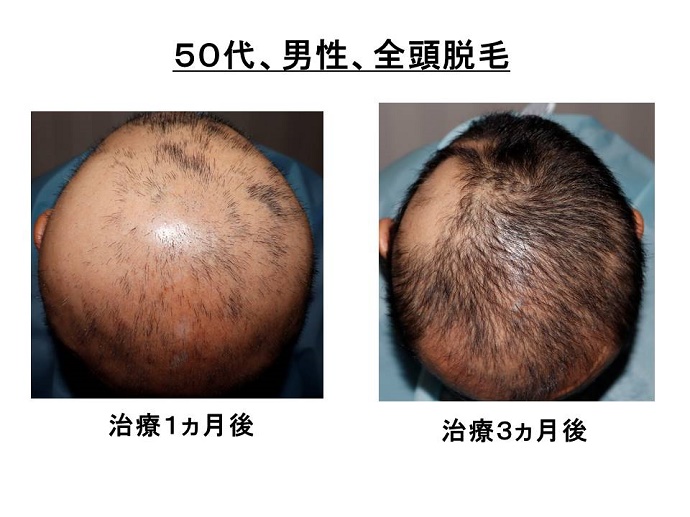 円形脱毛症　病院